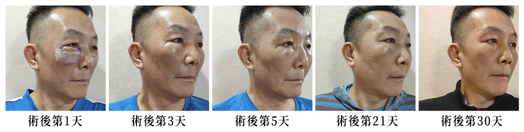 眼袋手術術後一個月的恢復紀錄